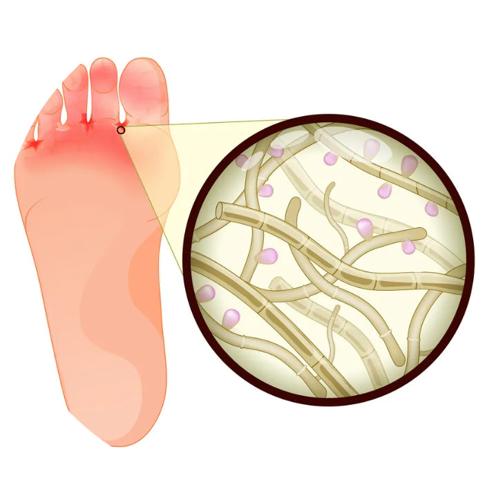 Athlete's Foot