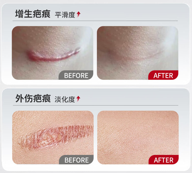 丹芎瘢痕涂膜, Danxiong Banhen Tumo, Dan Xiong Ban Hen Tu Mo, 20g, Effective Scar Reduction & Treatment Aid for Hyperplasia After Burn & Scald Healing